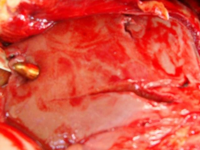 Bullet Embed in Liver