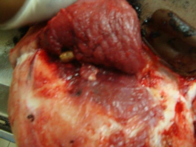 Bullet Embed in Temporal Muscles