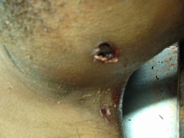 Bullet Jacket through Exit Wound