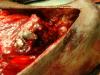 Exit of Bullet through Cervical spine