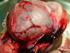 Fracture of Skull Infant