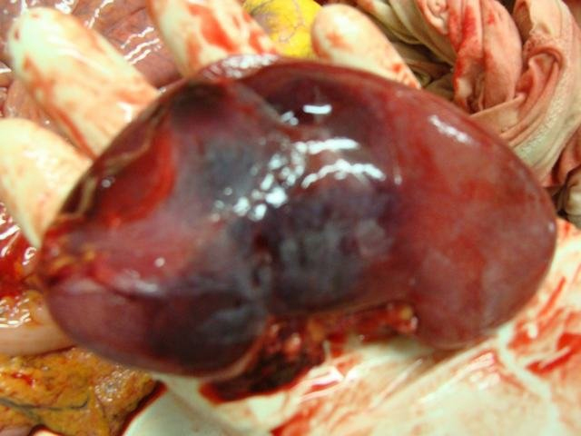 Renal Contusion