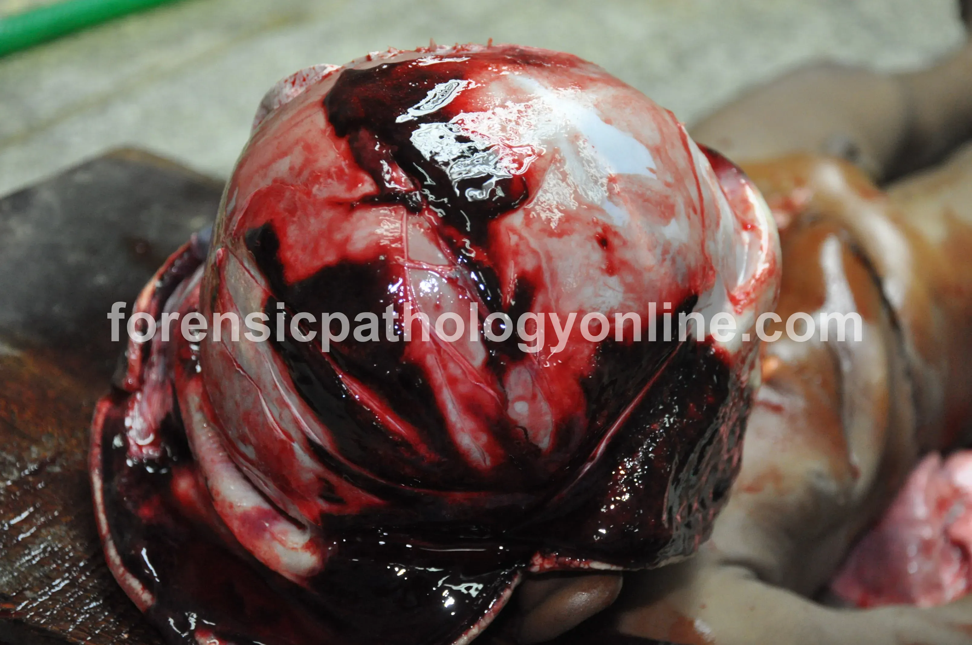 Blunt Force Injuries 12