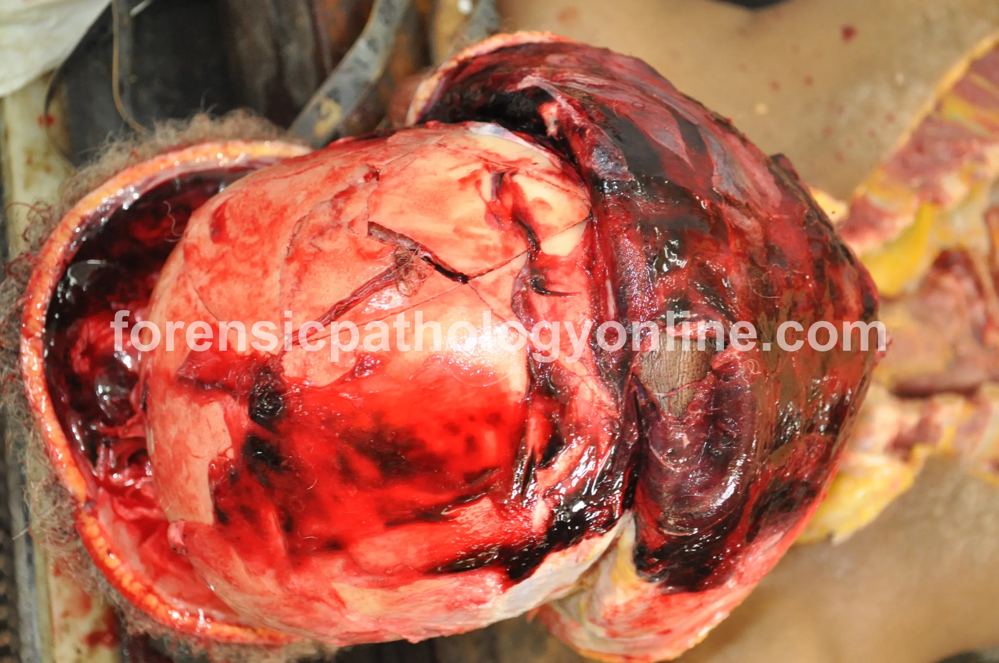 Blunt Force Injuries 8