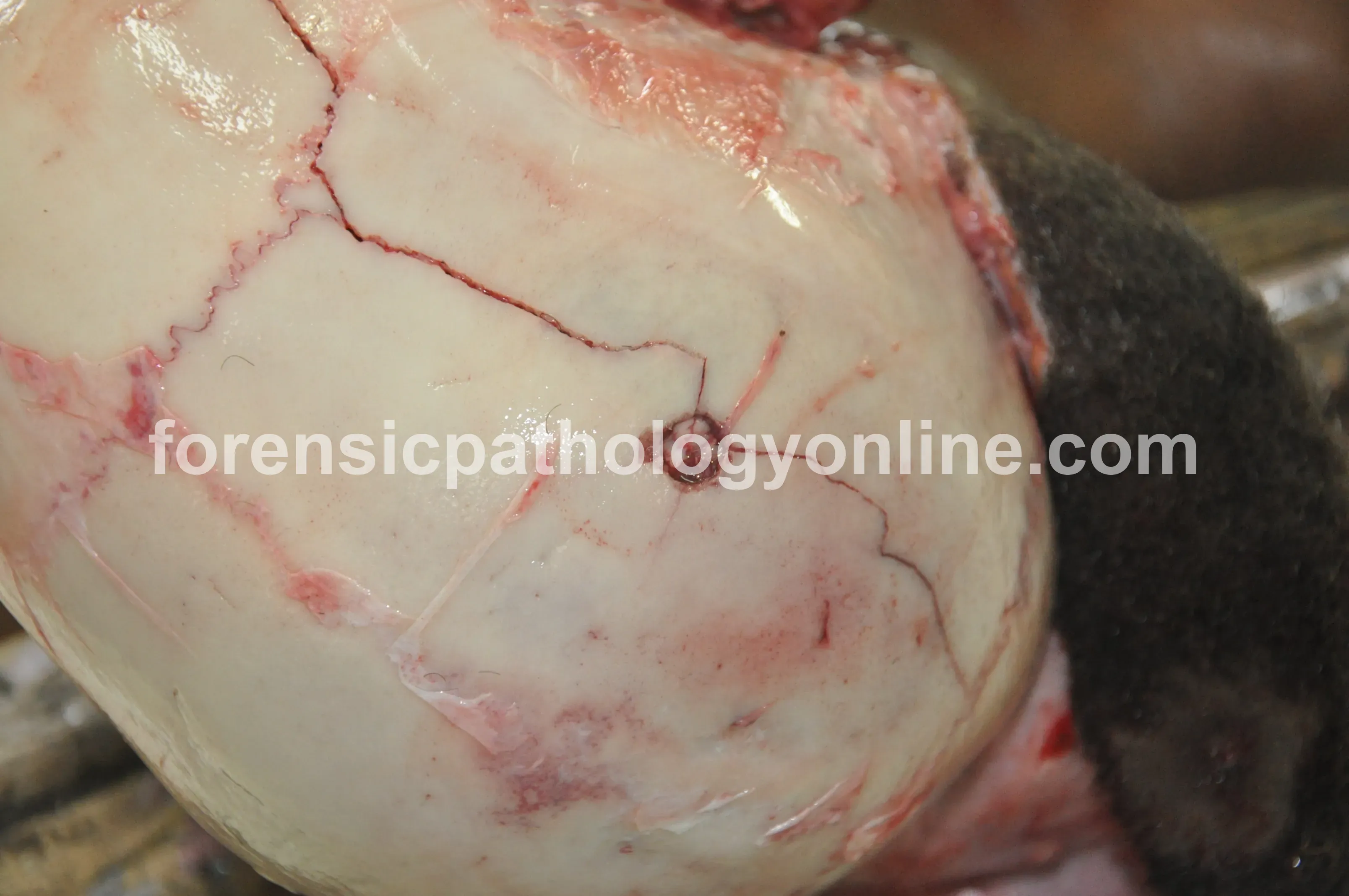 Blunt Force Injuries 9