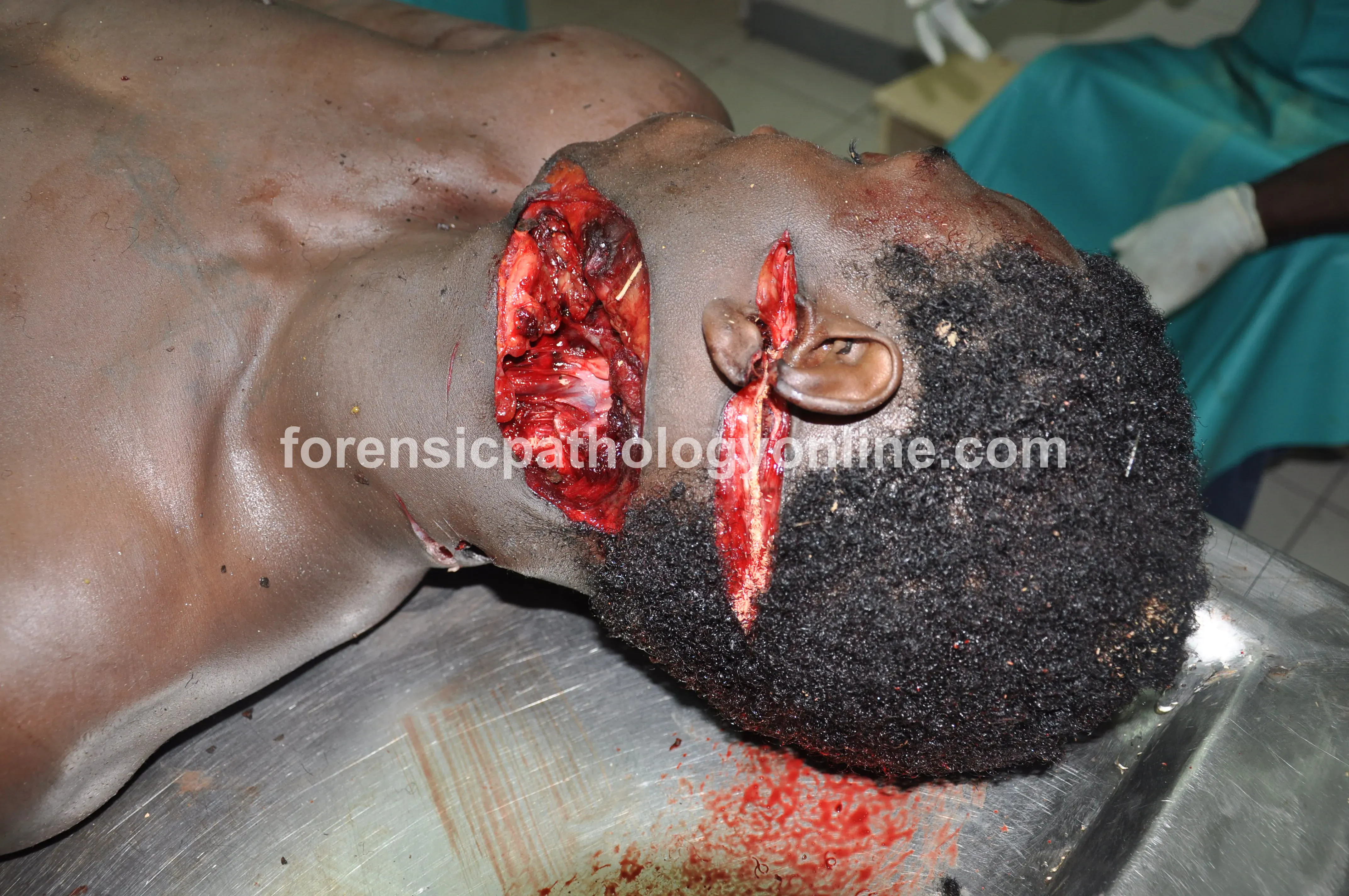 Sharp Force Injuries 10