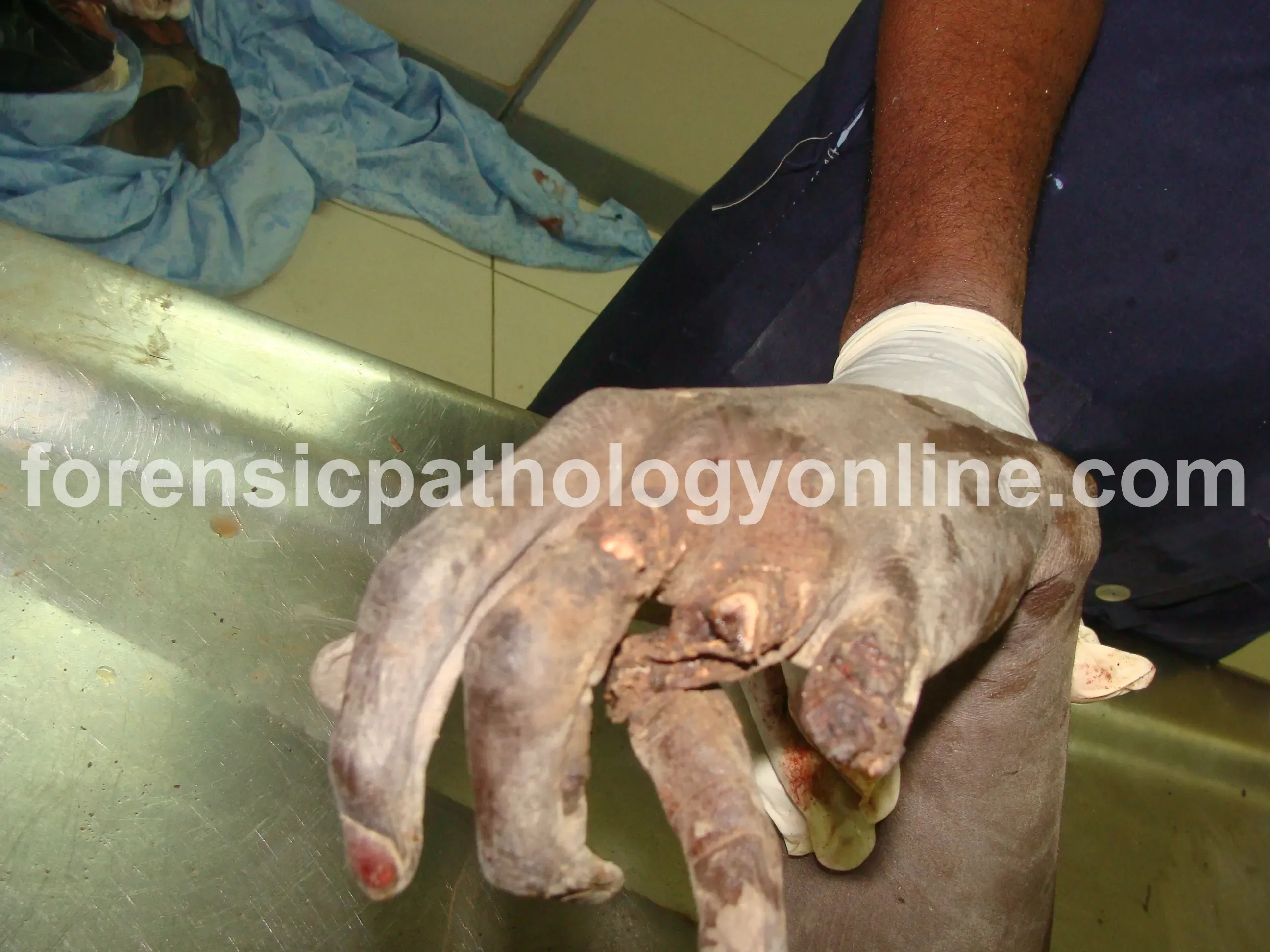 Sharp Force Injuries 11