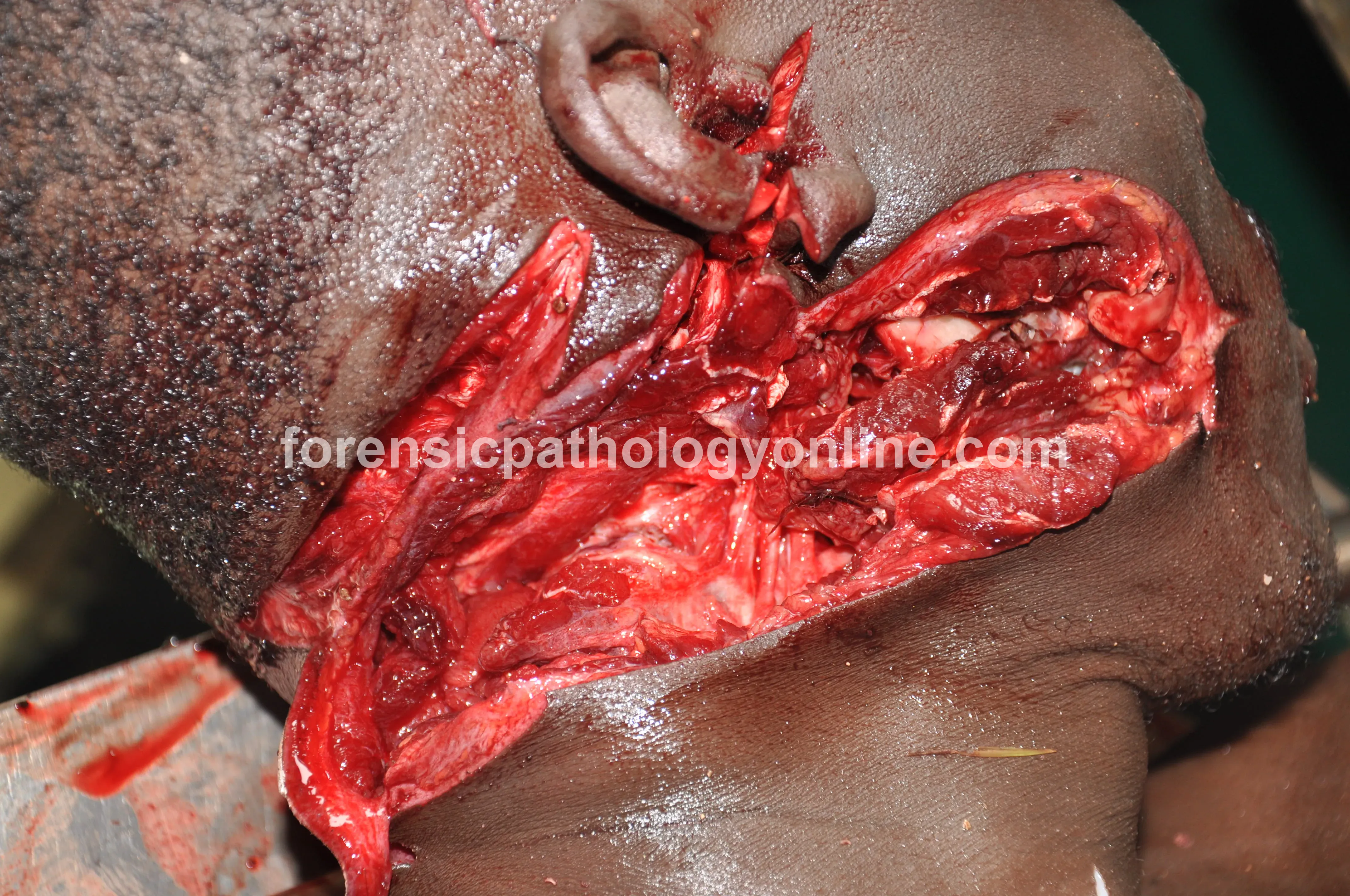 Sharp Force Injuries 12