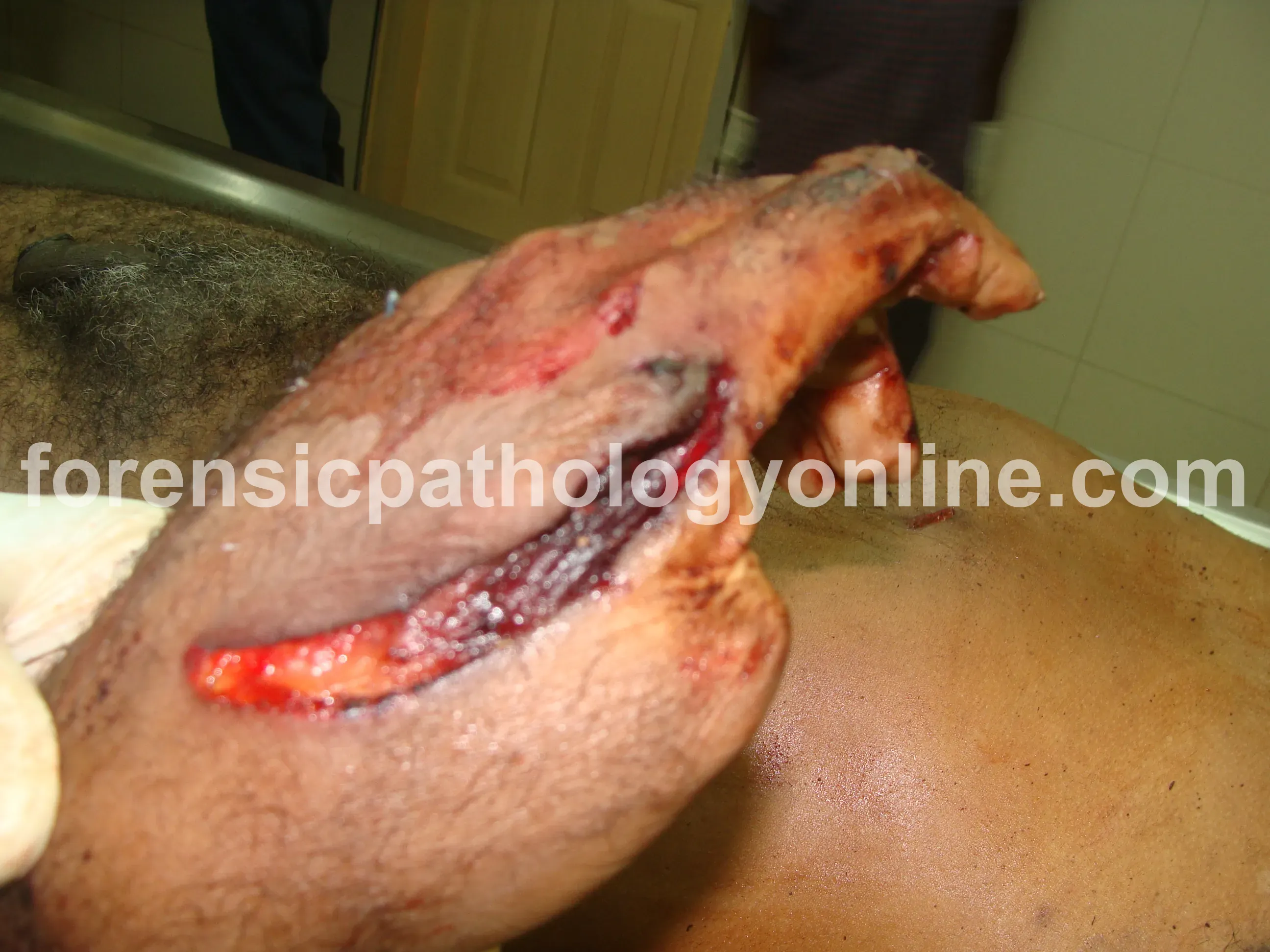 Sharp Force Injuries 6